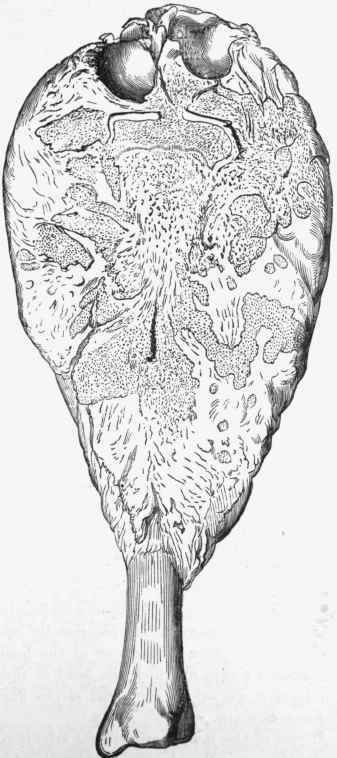 Osteoid chondroma of the tibia, divided obliquely.