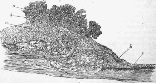 Portion of valve in ulcerative endocarditis.