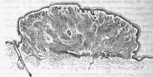 Section of a soft wart. It is covered with epidermis and consists of a very cellular tissue.