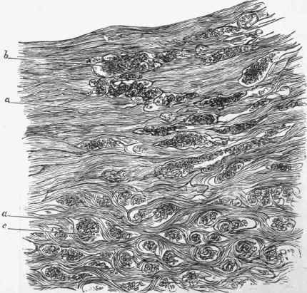 Section of cancer of uterus under a very low power, showing mode of advance into wall of uterus.