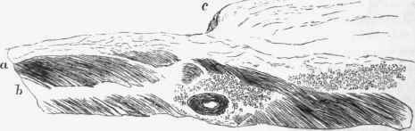 Soldier's spot on pericardium, b, Muscular wall of heart; a, pericardium, thickening at c so as to form spot, x 25.