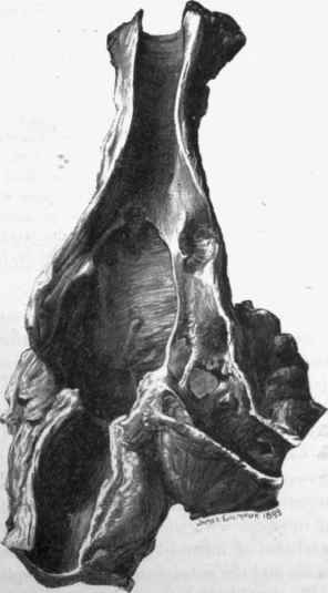 Syphilis of trachea and bronchi.