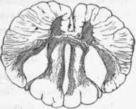 Syringomyelia. Cavities in each posterior cornu and in the middle line.