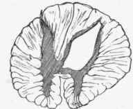 Syringomyelia. Cavity in one posterior cornu.