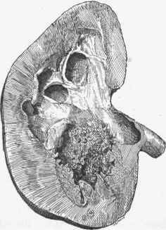 Tuberculosis of kidney with hydronephrosis.