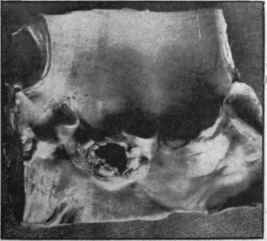 Ulcerative endocarditis affecting the aortic valve.
