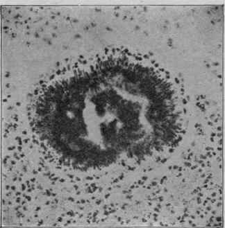 Actinomyces Cluster Showing Radial Striations at Periphery (Karg and Schmorl).