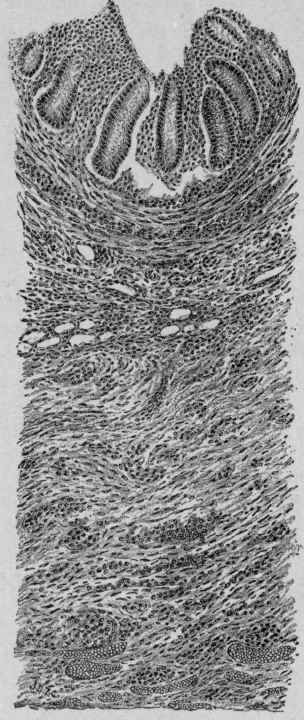 Acute Appendicitis with Round cell Infiltration and Hyperplasia of Connective Tissue in all of the Coats (Stengel).