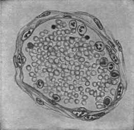 Acute Inflammation (Mallory).