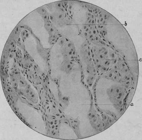 Acute Parenchymatous Nephritis (Catarrhal) (McFarland).