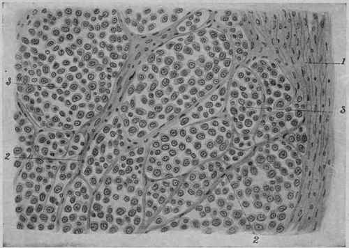 Alveolar Large Round celled Sarcoma from the Periosteum. X 250 (Dürck).