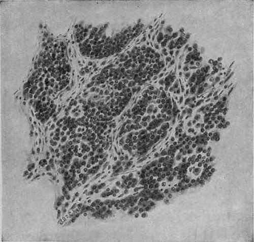 Alveolar Small Round cell Sarcoma. Zeiss, Oc. 4; ob. c.