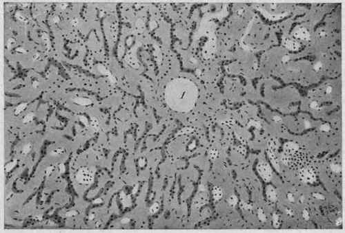 Amyloid Degeneration of the Liver. X 98 (Dürck).