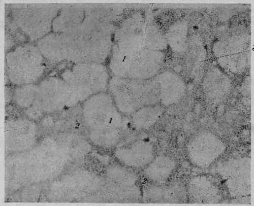 Amyloid Degeneration of the Spleen (Sago Spleen).