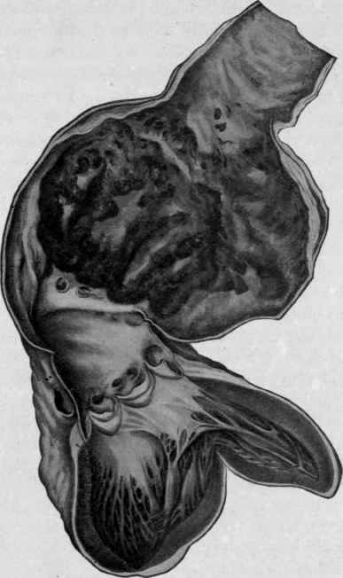 Aneurysm of the Arch of the Aorta (Bollinger).