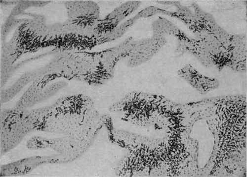 Anthracosis of the Lung. X 100 (Dürck).