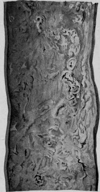 Atheroma of the Aorta (Bollinger).