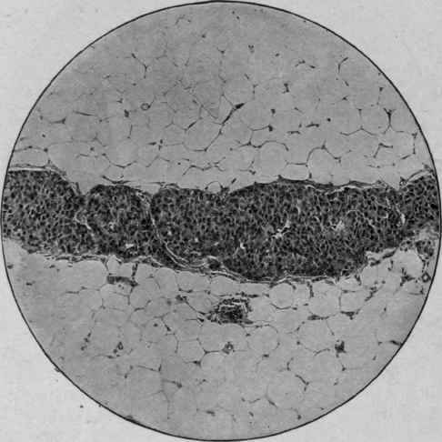Carcinoma of Mammary Gland (Mallory and Wolbach). Extension of tumor through a lymphatic in fat tissue.