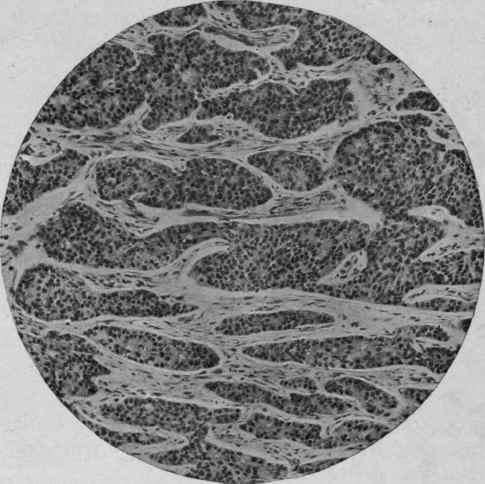 Carcinoma of Mammary Gland (Mallory).