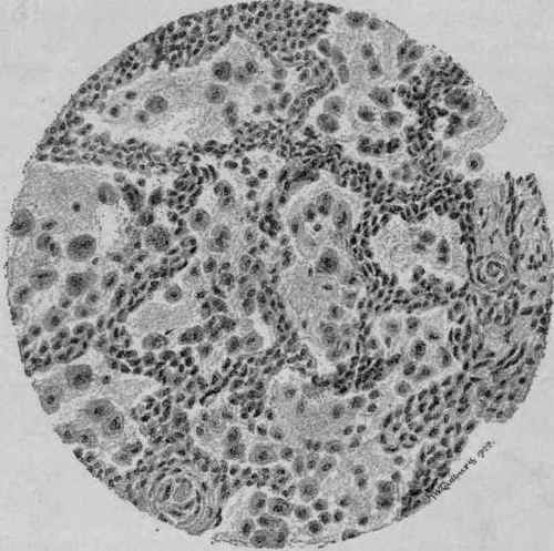 Catarrhal Pneumonia, showing Desquamated Epithelial Cells in the Alveolar Spaces (McFarland).