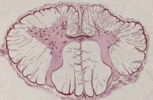Chronic Anterior Poliomyelitis (Collins).