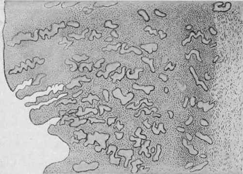Chronic Glandular Endometritis. X 40 (Dürck).