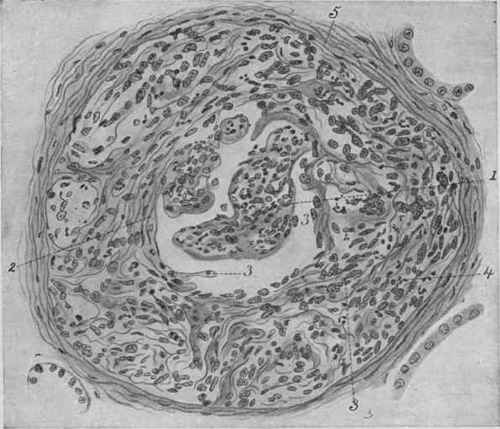 Chronic Glomerulonephritis. X 320 (Dürck).