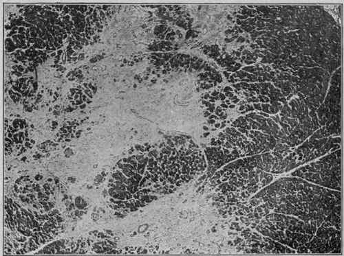 Chronic Interstitial Myocarditis. (Fibrous replacement hyperplasia).