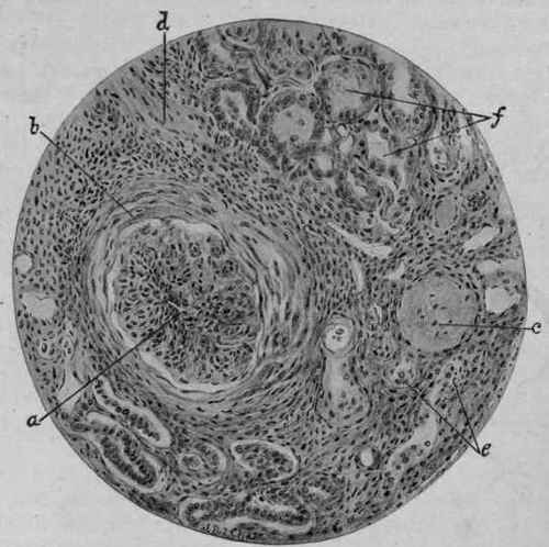 Chronic Interstitial Nephritis (McFarland).