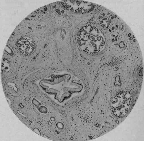 Chronic Interstitial Pancreatitis Following Duct Obstruction, showing Islands of Langerhans unchanged though Embedded in Sclerotic Tissue (Opie).