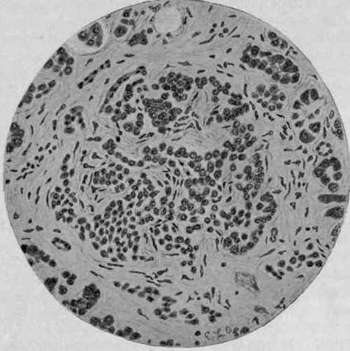 Chronic Interstitial Pancreatitis of Intra acinar Type, showing the Invasion of an Island of Langerhans by the Inflammatory Process (Opie).