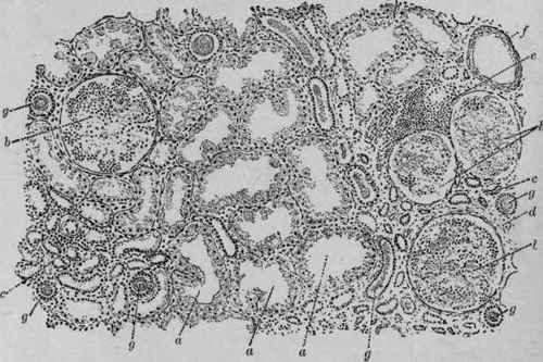 Chronic Parenchymatous Nephritis (Kaufmann).