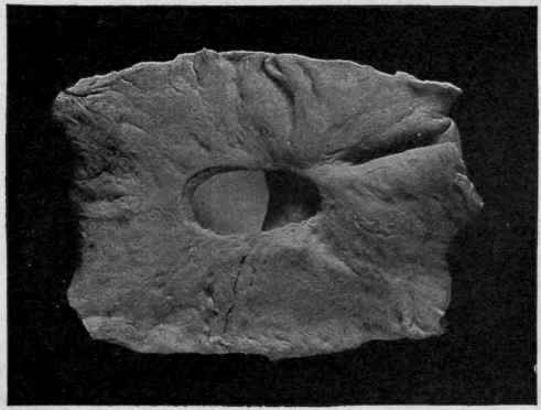 Chronic Perforating Ulcer of the Stomach (Delafield and Prudden).