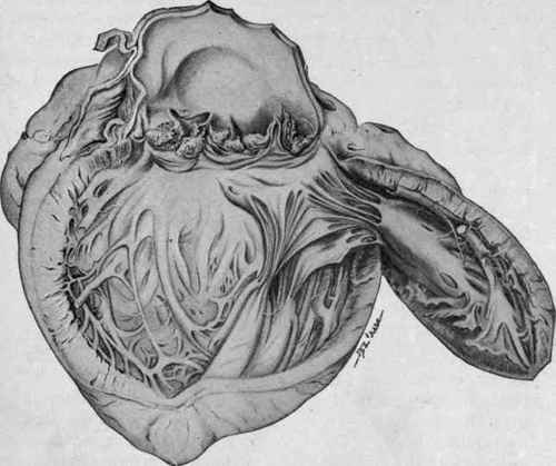 Chronic Verrucous Endocarditis of the Aortic Valves, showing the Warty Projections from Their Edges.