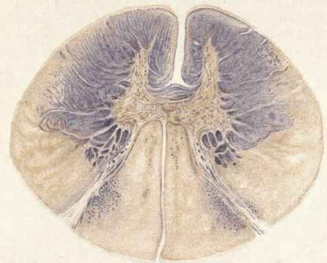 Combined Posterior and Lateral Sclerosis (Collins).