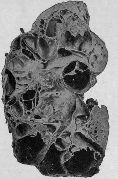 Congenital Cystic Kidney.