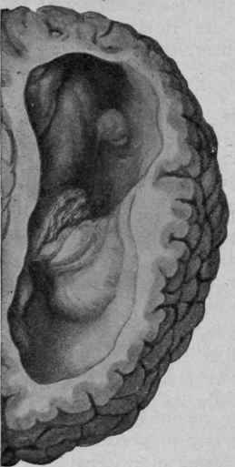 Congenital Internal Hydrocephalus, with Marked Atrophy of the White Substance (from Bollinger).