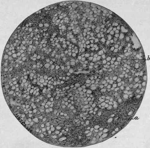 Fatty Infiltration of the Liver (McFarland). a, Periportal connective tissue; b, fat drops in liver cells.