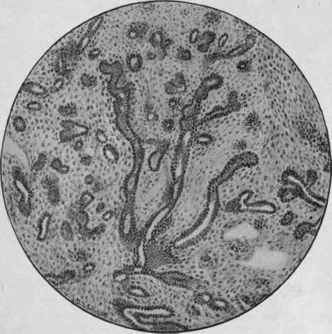 Flbro Adenoma Of The Mammary Gland (Canalicular Form).
