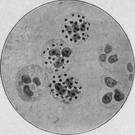 Gonococci in Urethral Pus (McFarland).