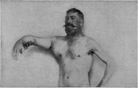 Hodgkin's Disease (Stengel).