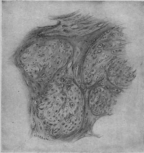 Hyaline Chondroma. Oc. 2; ob. 3 (McFarland).