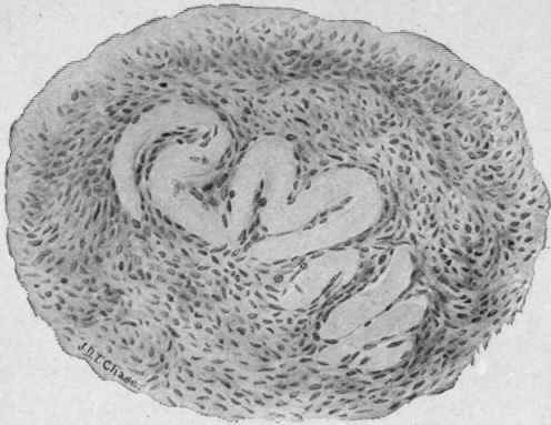 Hyaline Degeneration of an Ovarian Capillary. Oc. 2; ob. 9 (McFarland).