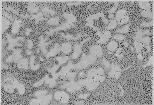 Hyaline Degeneration of the Reticulum of a Lymph gland in Tuberculosis. X 280 (Durck).