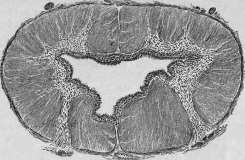 Hydromyelia (Partly Diagrammatic) (Stengel).