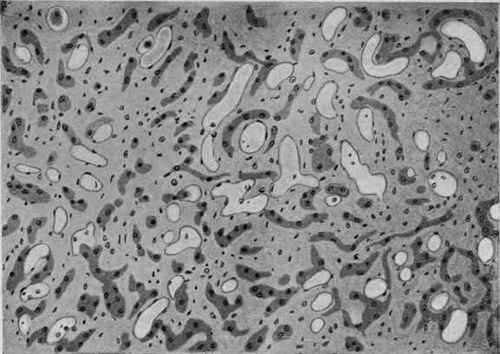 (Hypertrophic) Diffuse Cirrhosis of the Liver. X 160 (D�rck).