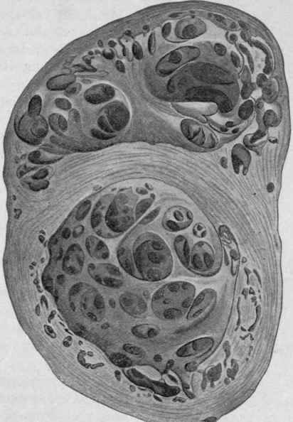 Hypertrophy and Dilatation of the Heart (Bollinger).
