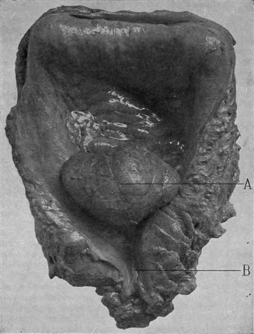Hypertrophy of the Middle Lobe of the Prostate (White and Wood).