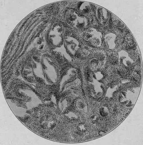 Hypertrophy of the Prostate Gland (McFarland).