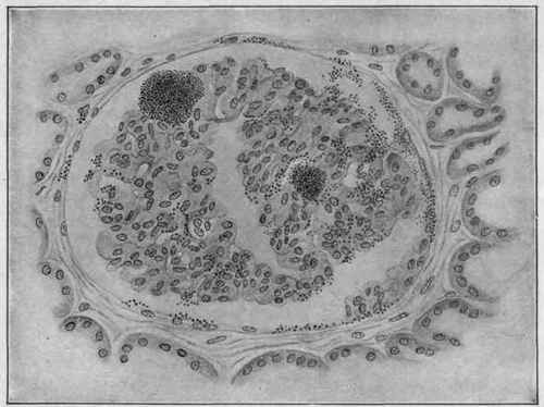Infectious Embolism of the Kidney Following Endocarditis and Showing Groups of Staphylococci in a Glomerulus (Dürck).